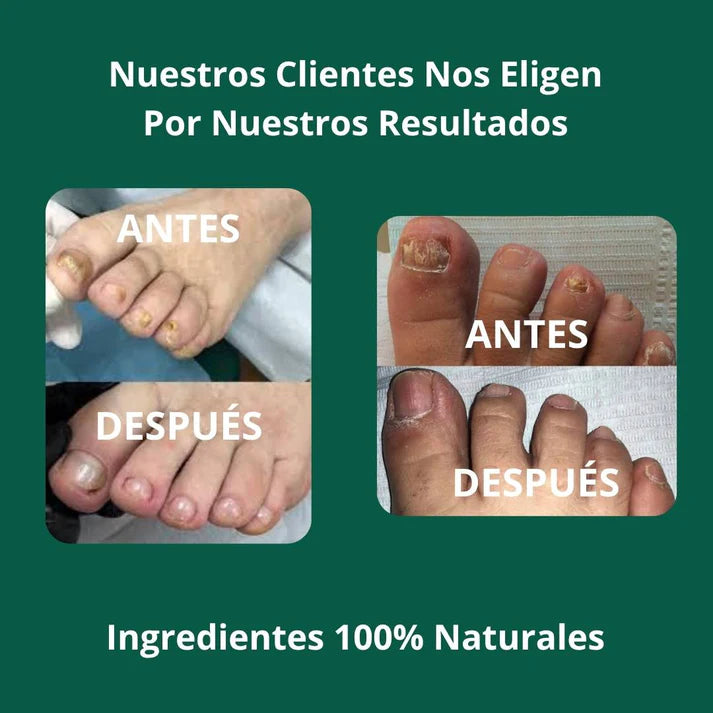 🦶 ELIMINA LOS HONGOS Y RECUPERA UÑAS SANAS ✨ ¡Llévate 2 y Paga 1!