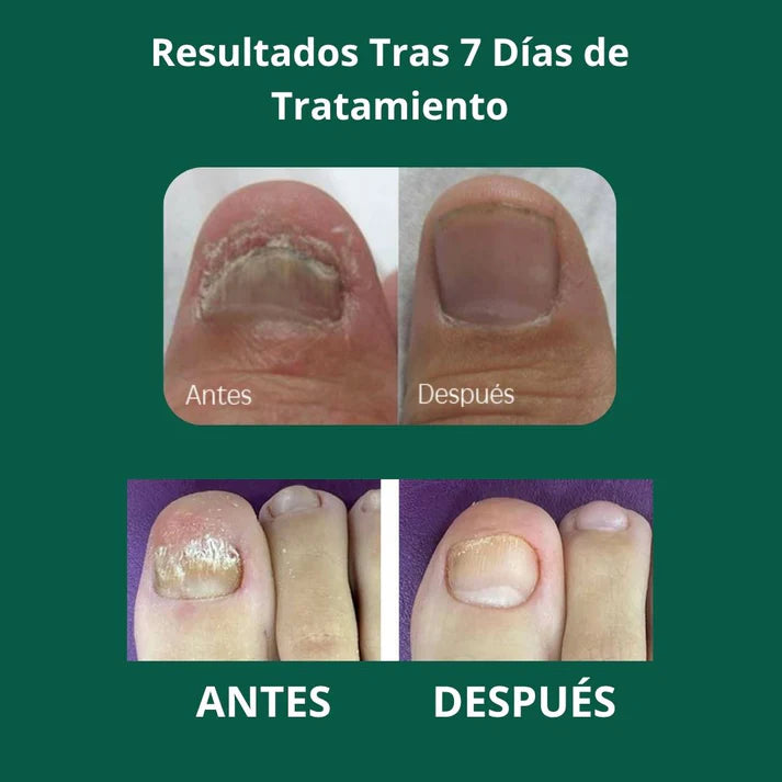 🦶 ELIMINA LOS HONGOS Y RECUPERA UÑAS SANAS ✨ ¡Llévate 2 y Paga 1!
