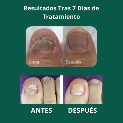 🦶 ELIMINA LOS HONGOS Y RECUPERA UÑAS SANAS ✨ ¡Llévate 2 y Paga 1!